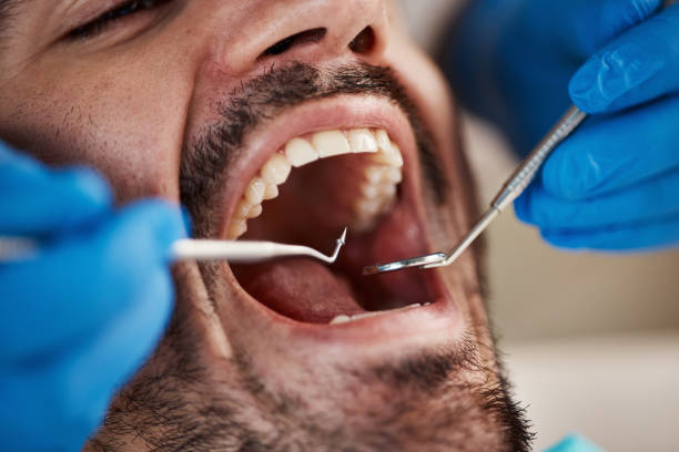 Best Dentist for Tooth Abscess  in Union Park, FL